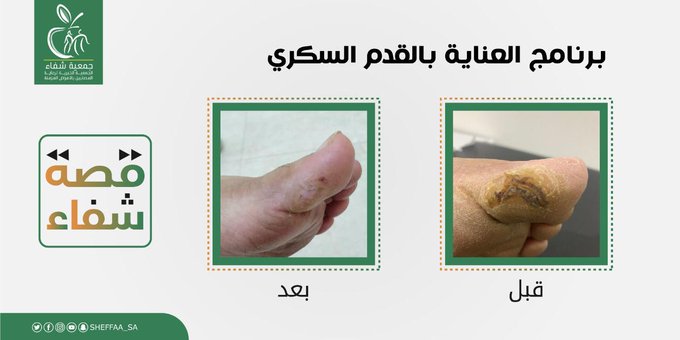 قصة شفاء